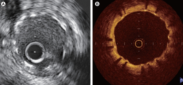 IVUS vs OCT cross-sectional comparison